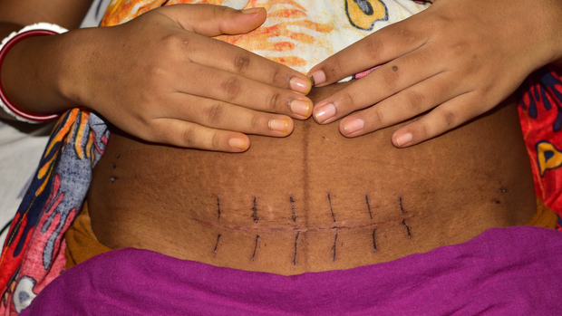 Picture showing a Black person's belly with a csection scar. This photo shows what postpartum healing looks like and the spot where you could put a padsicle