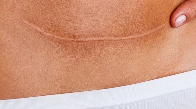 Close-up photo of a low transverse c-section scar which is a few inches from the pubic hair line and arches much like a smile.